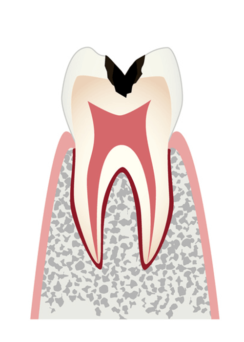 歯の内部まで進行した虫歯